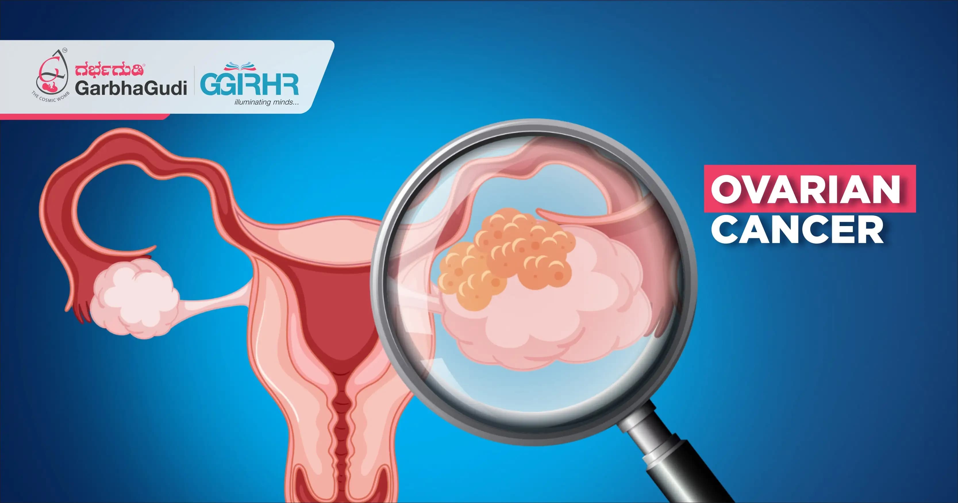 Ovarian Cancer